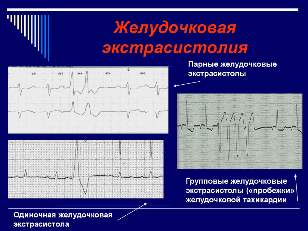 Экстрасистолы 4. ЭКГ монотопные желудочковые экстрасистолы. Наджелудочковая экстрасистола на ЭКГ. Экстрасистолия желудочков на ЭКГ. Групповая желудочковая экстрасистолия на ЭКГ.