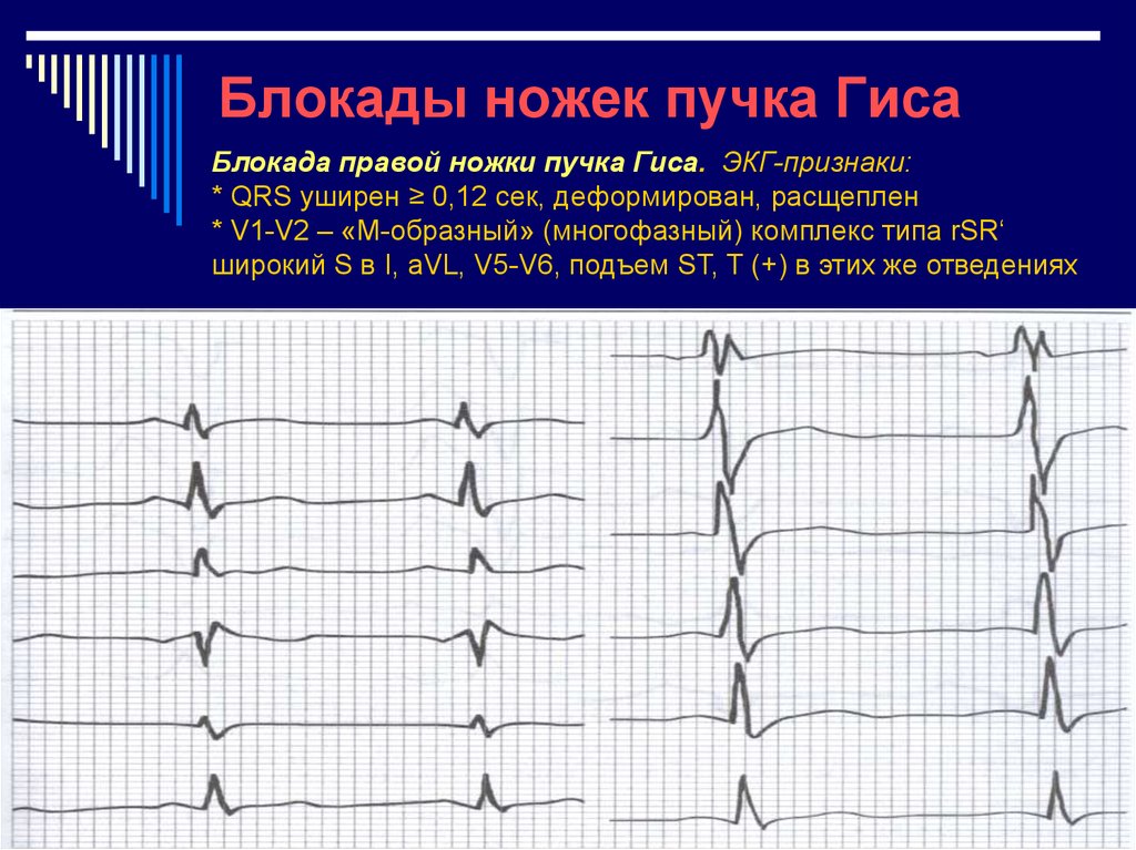 Пучка гиса на экг. Блокада правой ножки пучка Гиса на ЭКГ. Блокада ножки пучка Гиса на ЭКГ. Блокада левой ножки пучка Гиса на ЭКГ. ЭКГ блокада левой ножки пучка.