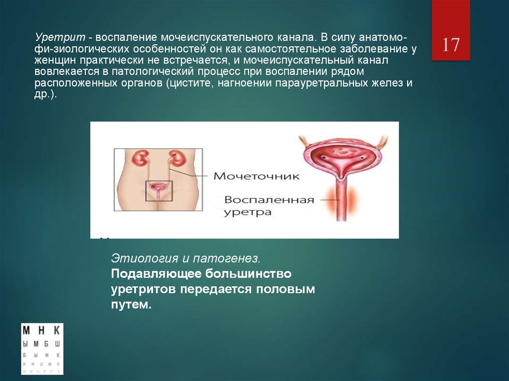 Уретрит у женщин. Мочеиспускательного канала (уретрит). Воспаление уретры у женщин. Уретрит воспаление уретры.