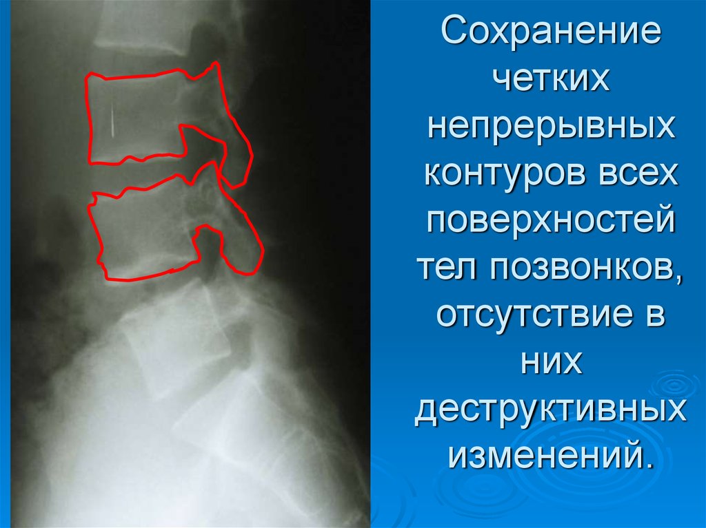 Склероз и краевые остеофиты. Поверхность тела позвонка. Костные заострения тел позвонков. Краевые костные разрастания тел позвонков что это такое. Контуры тел позвонков заострены.