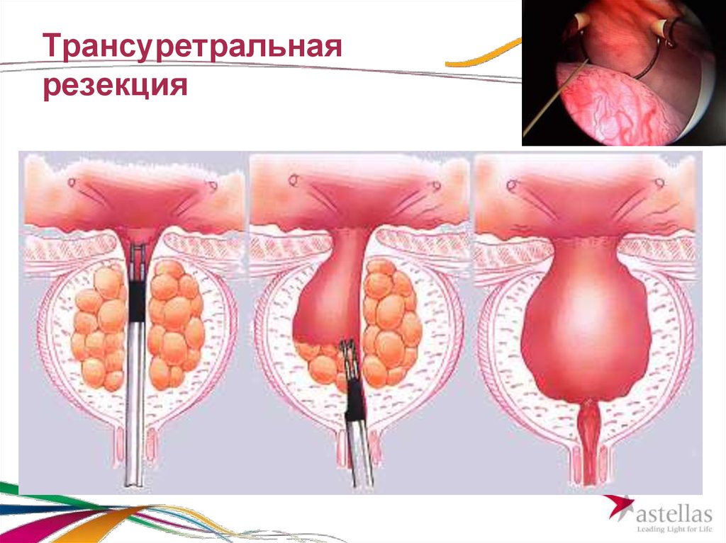 Гиперплазия предстательной железы операция