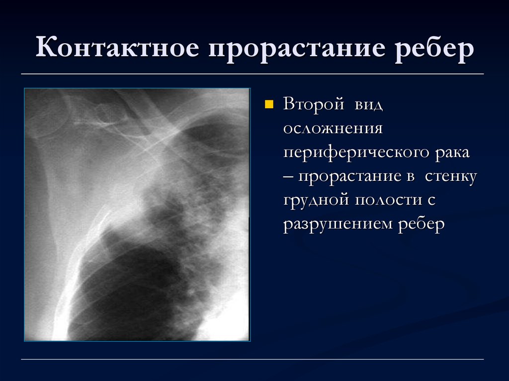 Лучевая диагностика рака легкого презентация