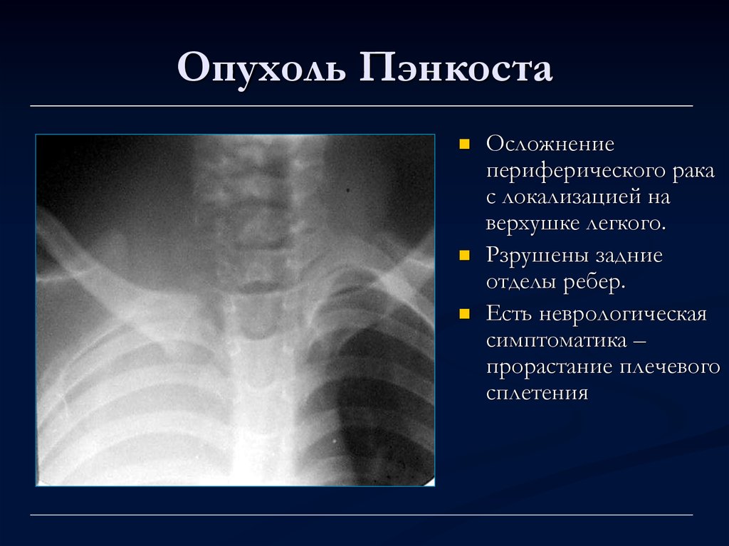 Лучевая диагностика рака легкого презентация