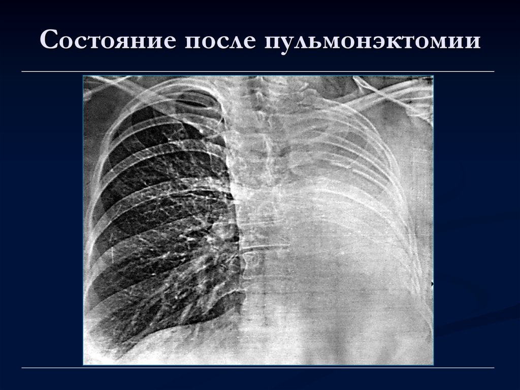 Пневмоторакс лучевая диагностика презентация