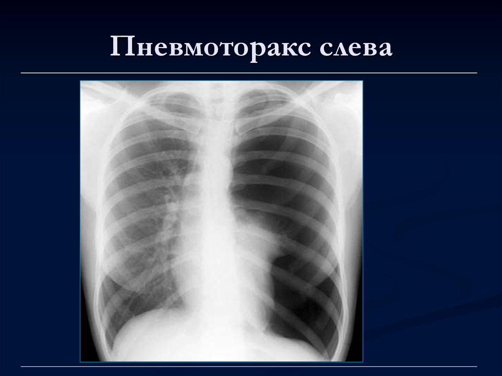 Лучевая диагностика легких презентация