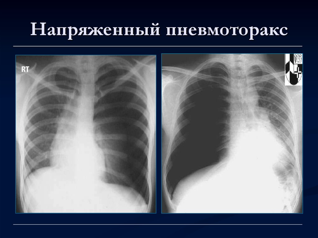 Лучевая диагностика легких презентация