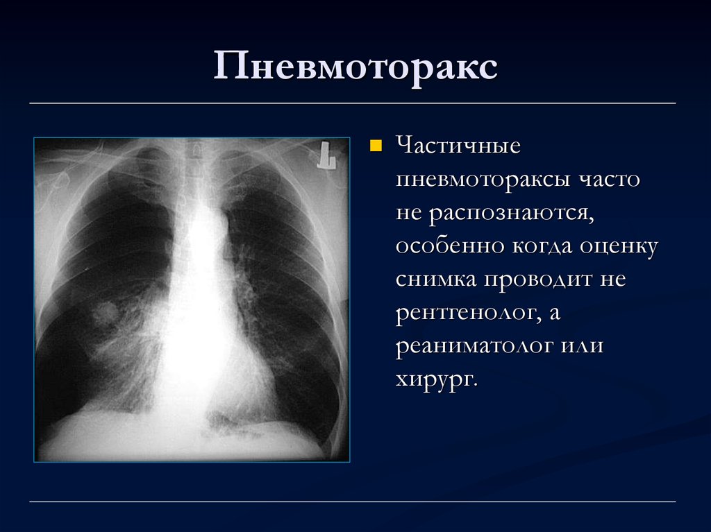 Пневмоторакс лучевая диагностика презентация