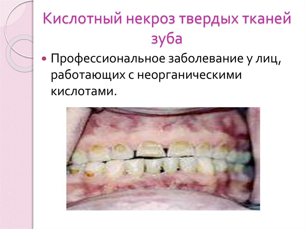Кислотный некроз твердых тканей зуба