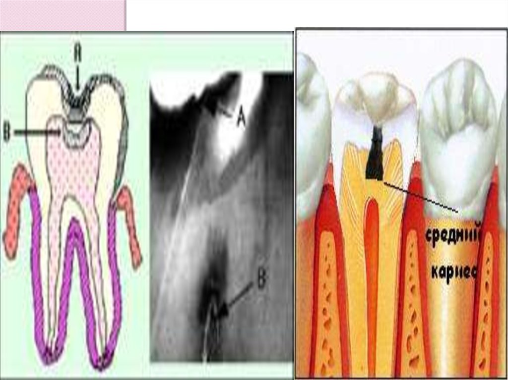 Патология твердых тканей. Клиновидный дефект с кариесом. Зубы клиновидный кариес.