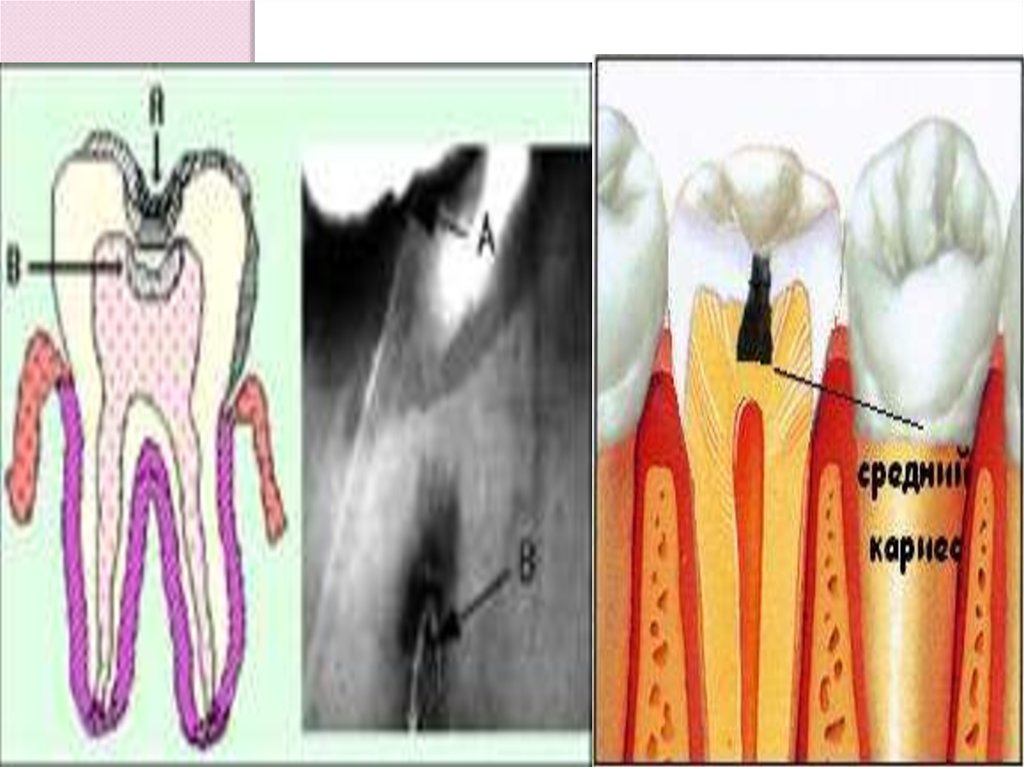 Твердые ткани зуба. Средний кариес и клиновидный дефект. Клиновидный дефект ткани зуба. Средний кариес 1 поверхность.