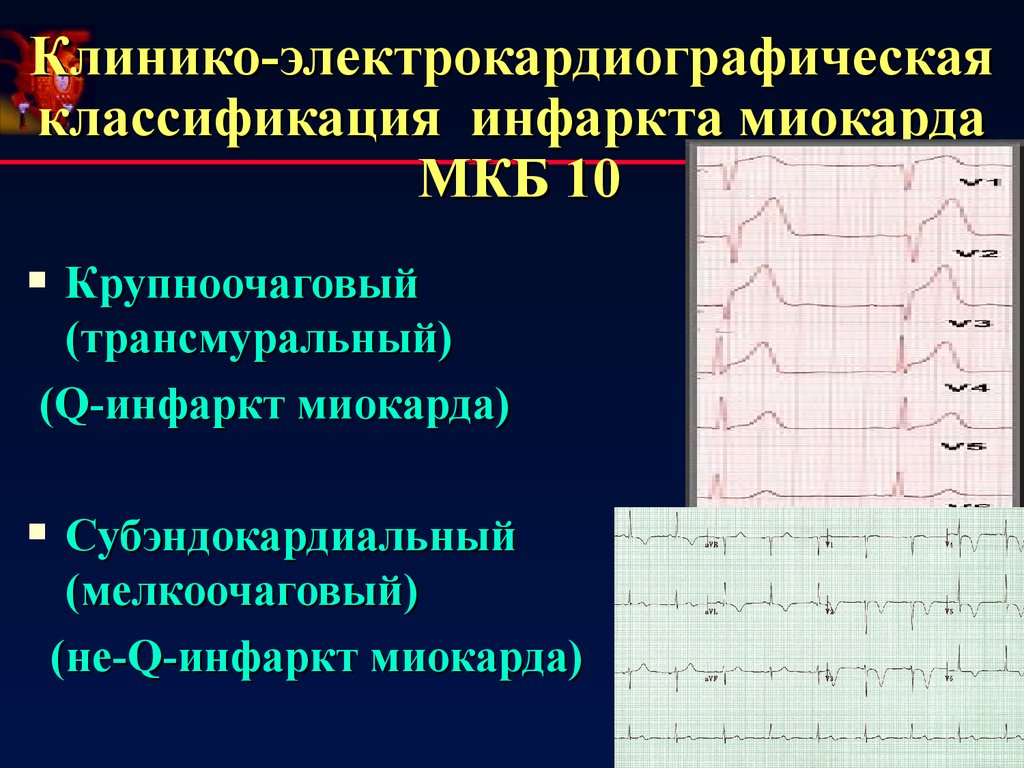 Трансмуральный инфаркт миокарда. Острый субэндокардиальный инфаркт миокарда ЭКГ. Инфаркт миокарда классификация ЭКГ. Субэндокардиальный инфаркт на ЭКГ. Мкб острый мелкоочаговый инфаркт миокарда.