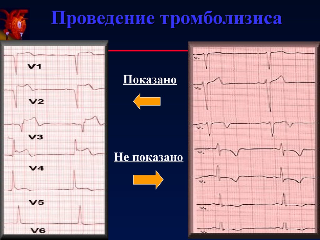 Экг после. ЭКГ после тромболизиса. ЭКГ при тромболизисе. Окс инфаркт ЭКГ. ЭКГ при коронарной недостаточности.