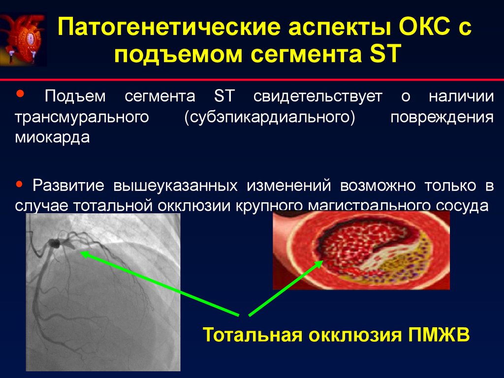 Острый коронарный синдром