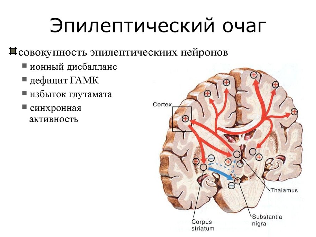 Очаг мозга. Эпилепсия очаг поражения. Очаги эпилепсии в головном мозге. Очаг поражения при эпилепсии. Эпилептический очаг в мозге.