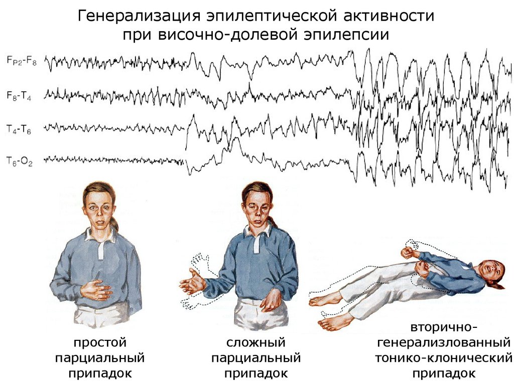 Эпилептический припадок у взрослых