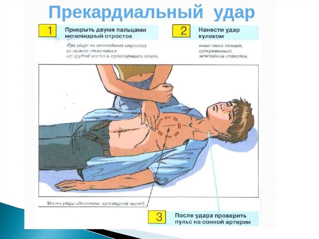 Прекардиальный удар при первой помощи. Мечевидный отросток грудины СЛР. Алгоритм проведения прекардиального удара. Прекардиальный удар непрямой массаж сердца.