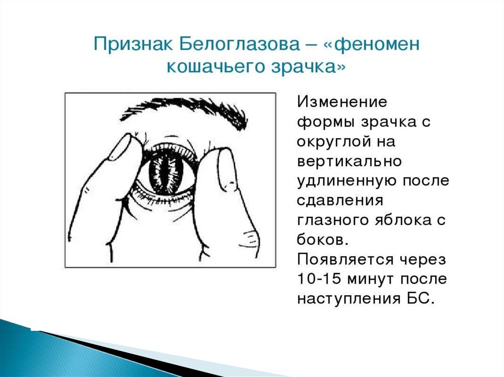 Признаки глазков. Признак Белоглазова – «феномен кошачьего зрачка». Симптом Белоглазова кошачий глаз. Признак Белоглазова кошачий зрачок. Симптом Белоглазова (симптом «кошачьего зрачка»).