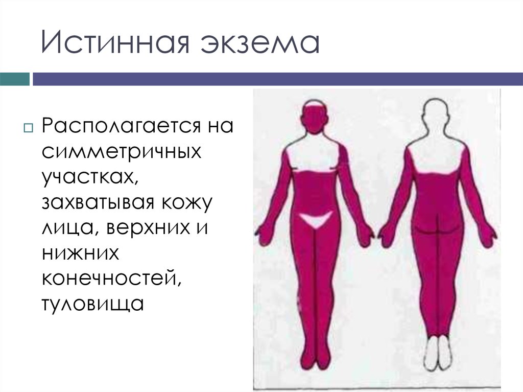 Истинная экзема