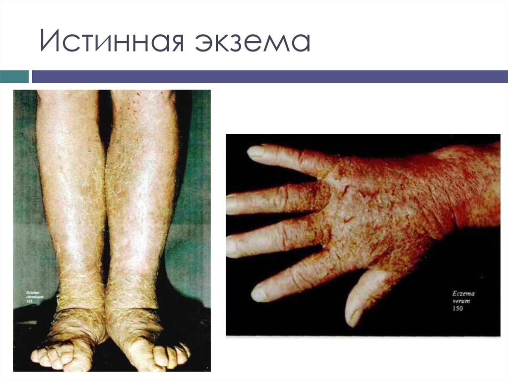 Истинная экзема
