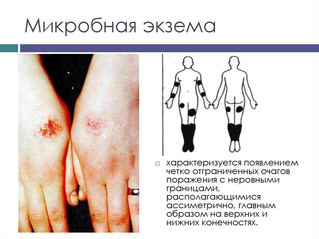 Микробная экзема