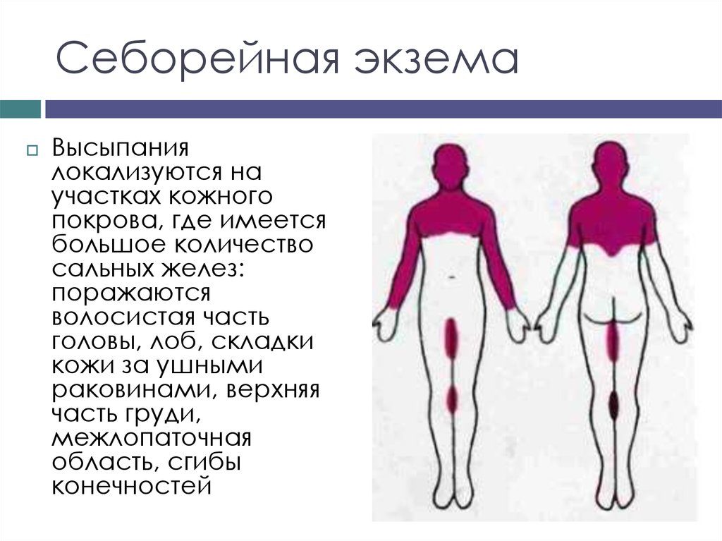 Себорейная экзема