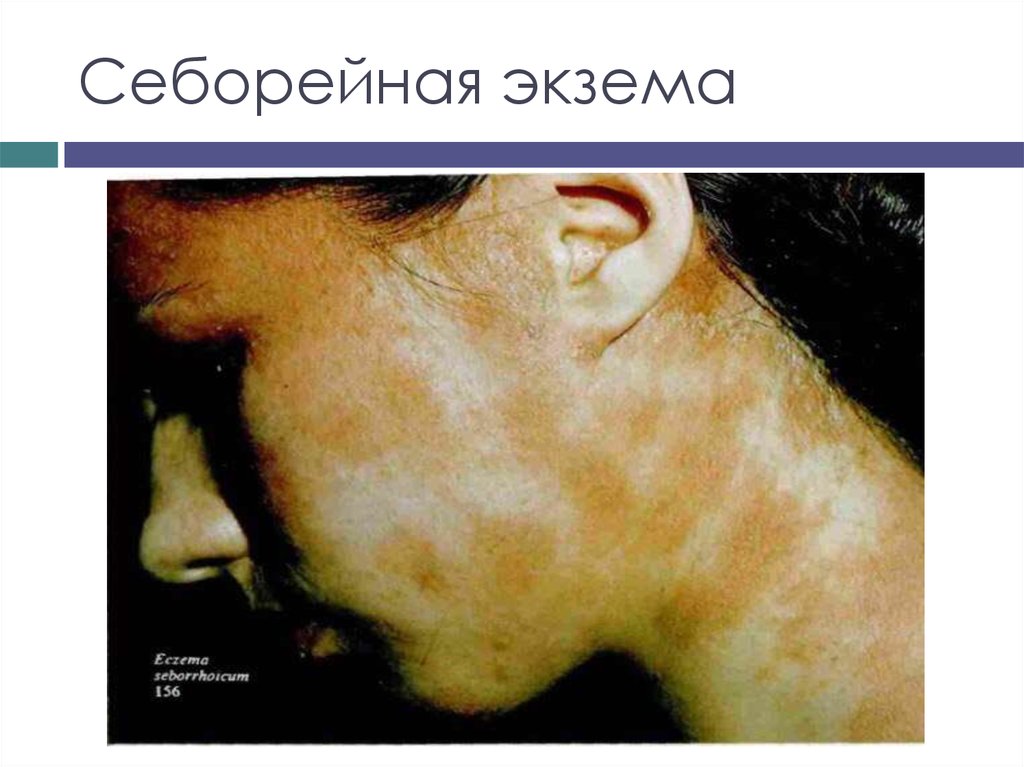 Экзема. Факторы, вызывающие экзему - online presentation