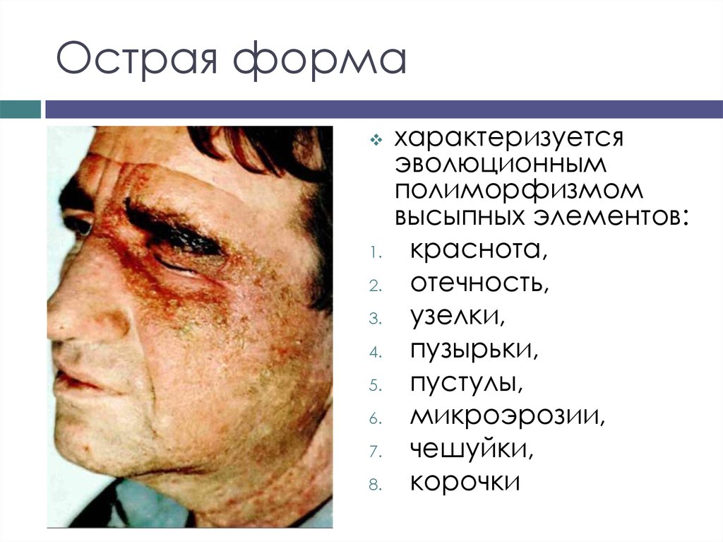 Острая форма