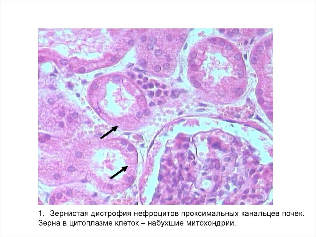 Дегенерация эпителия