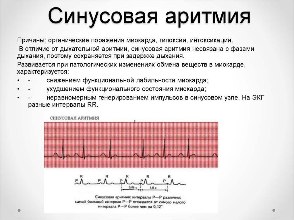 Что значит синусовый ритм сердца на экг. Синусовая аритмия с ЧСС 80-100 уд/мин. Синусовая аритмия на ЭКГ. Лечится ли синусовая аритмия сердца. ЭКГ при нарушениях ритма сердца у детей.