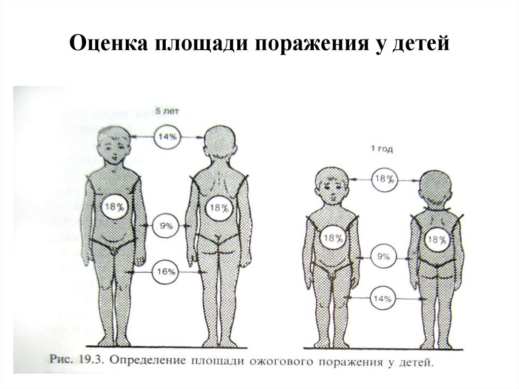 Площадь поражения при ожогах. Площадь поражения при ожогах у детей. Определение площади поражения. Оценка площади поражения..