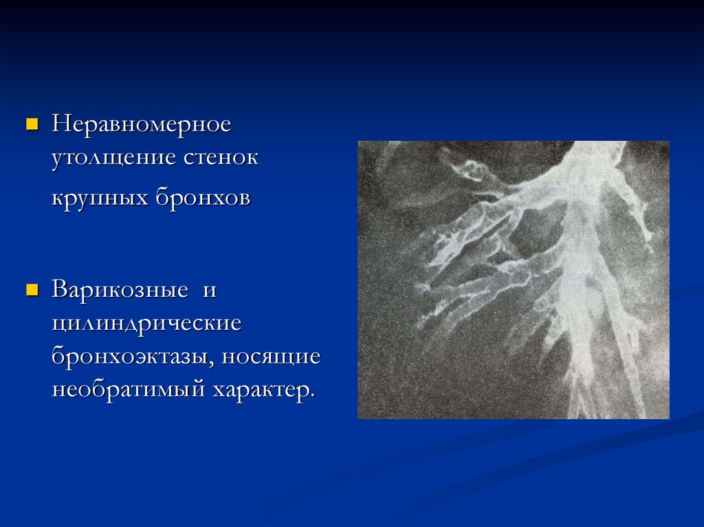 Утолщение стенок. Утолщение стенок бронхов. Утолщенные стенки бронхов что это. Утолщение стенок крупных бронхов. Цилиндрические бронхоэктазы.