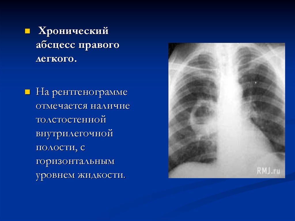 Хронический легких. Хронический абсцесс легкого рентген. Абсцесс легкого рентген описание. Абсцесс легкого описание рентгенограммы. Абсцесс легкого с горизонтальным уровнем жидкости.