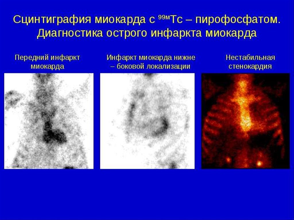 Презентация сцинтиграфия миокарда