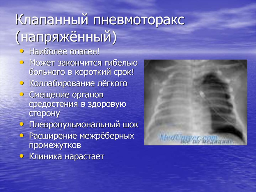 Напряженный пневмоторакс. Рентген грудной клетки пневмоторакс. Тотальный левосторонний пневмоторакс. Гидропневмоторакс и пневмоторакс. Клапанный пневмоторакс рентген описание.