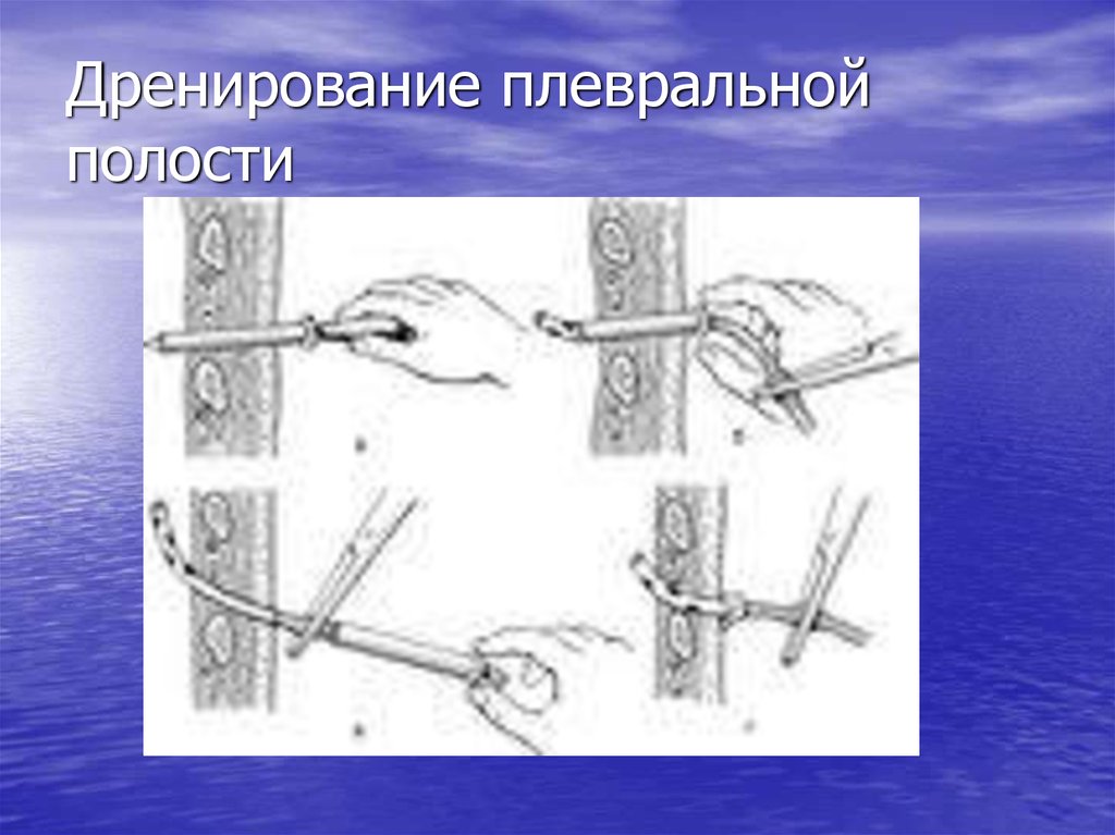 Дренирование плевральной полости. Дренирование плевральной полости техника. Дренирование плевральной полости на догоспитальном этапе. Виды дренирования плевральной полости.