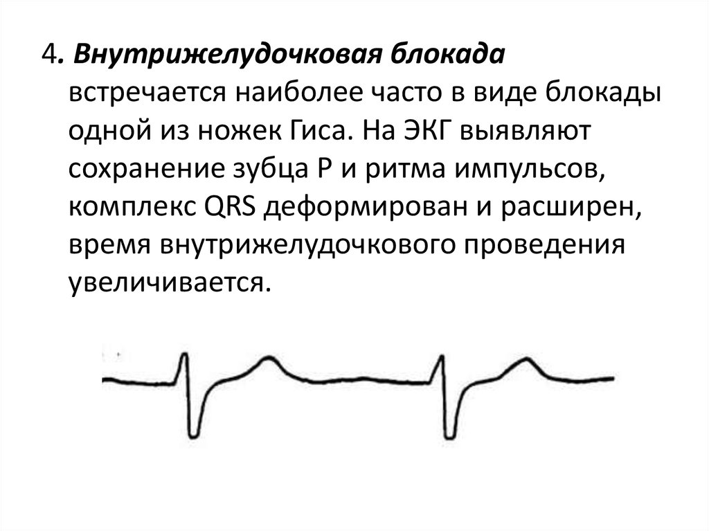 Очаговое нарушение внутрижелудочковой. Внутрижелудочковая блокада на ЭКГ. Очаговая внутрижелудочковая блокада на ЭКГ. Неспецифическая внутрижелудочковая блокада на ЭКГ. Локальная внутрижелудочковая блокада на ЭКГ.