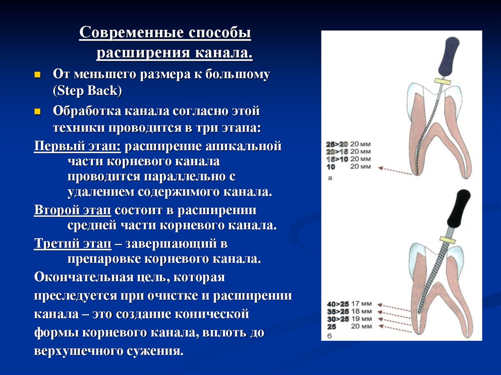 Эндодонтическая обработка корневого канала