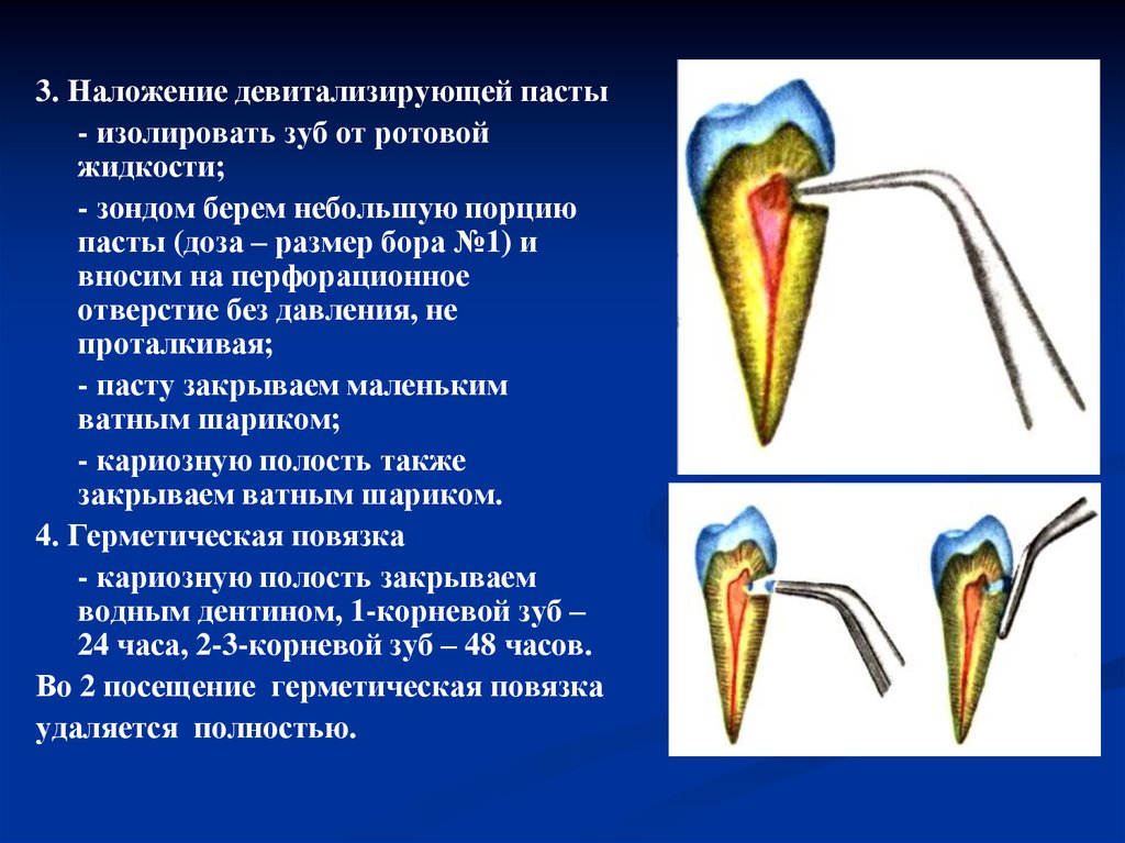 Как выглядит мышьяковая паста для зубов фото