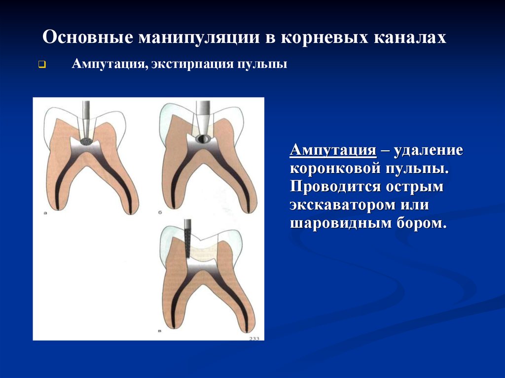 Метод ампутации пульпы. Пульпотомия ампутация коронковой пульпы временного зуба. Методика девитальной ампутации пульпы. Девитальная пульпотомия. Девитальная ампутация временных зубов.