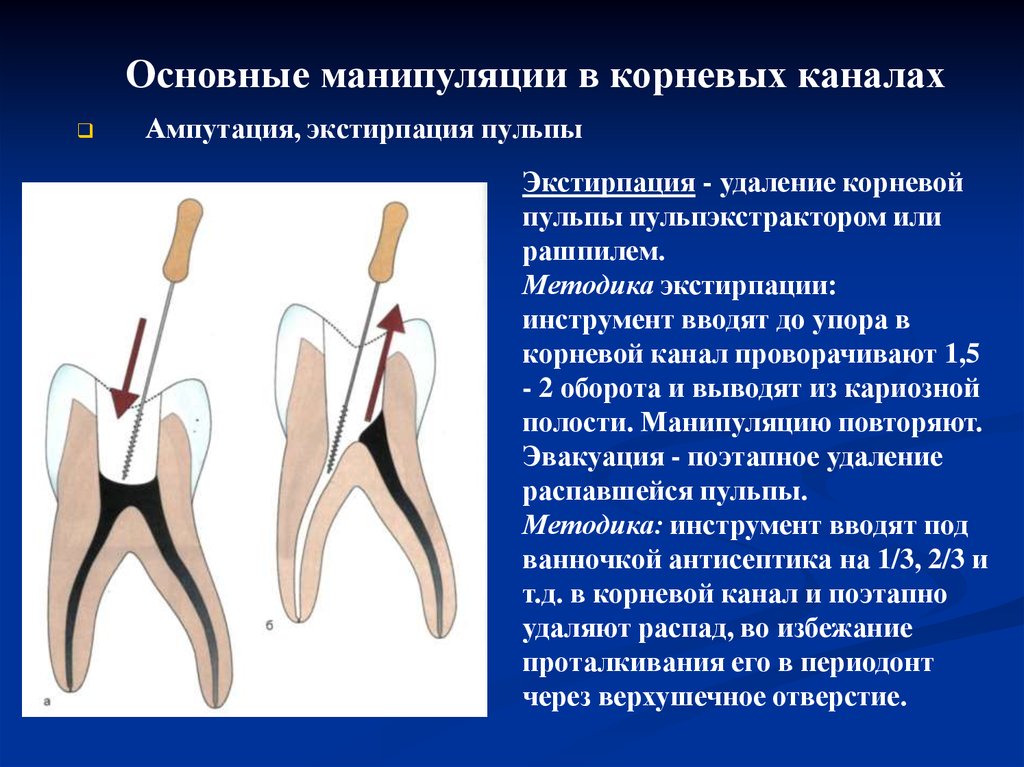 Определение корневых каналов. Витальная экстирпация пульпы методика. Девитальная экстирпация зуба. Метод витальной экстирпации пульпы (Пульпэктомия). Инструменты для удаление распада коронковой и корневой пульпы.