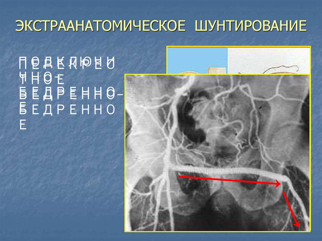 ЭКСТРААНАТОМИЧЕСКОЕ ШУНТИРОВАНИЕ