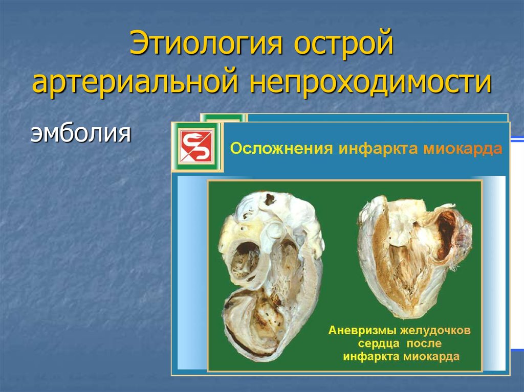 Этиология острой артериальной непроходимости