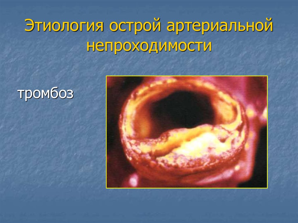 Этиология острой артериальной непроходимости