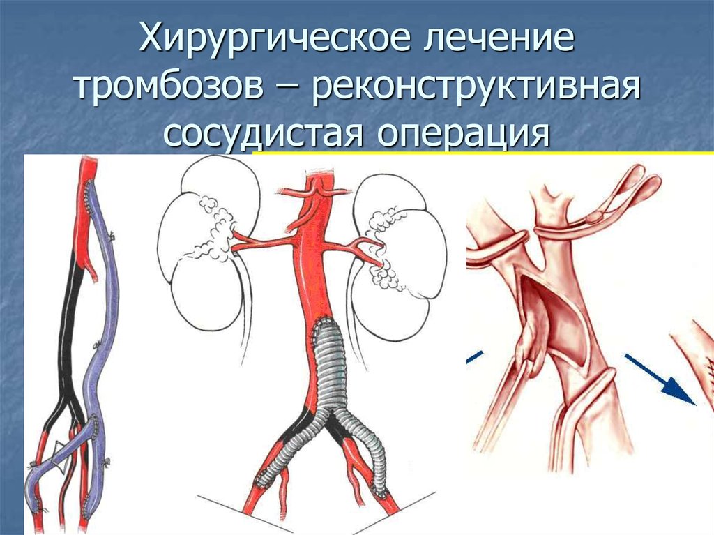 Хирургическое лечение тромбозов – реконструктивная сосудистая операция