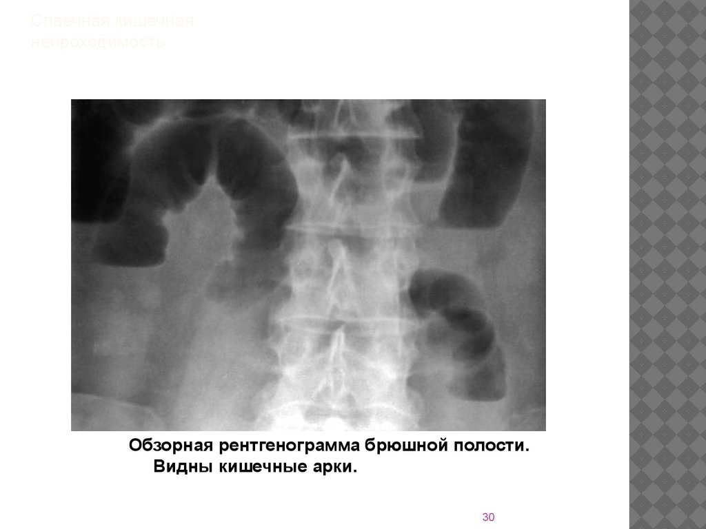 Обзорная рентгенография брюшной полости. Тонкокишечная непроходимость рентген. Арки при кишечной непроходимости рентген. Кишечная непроходимость обзорная рентгенография. Толстокишечная непроходимость рентгенография.