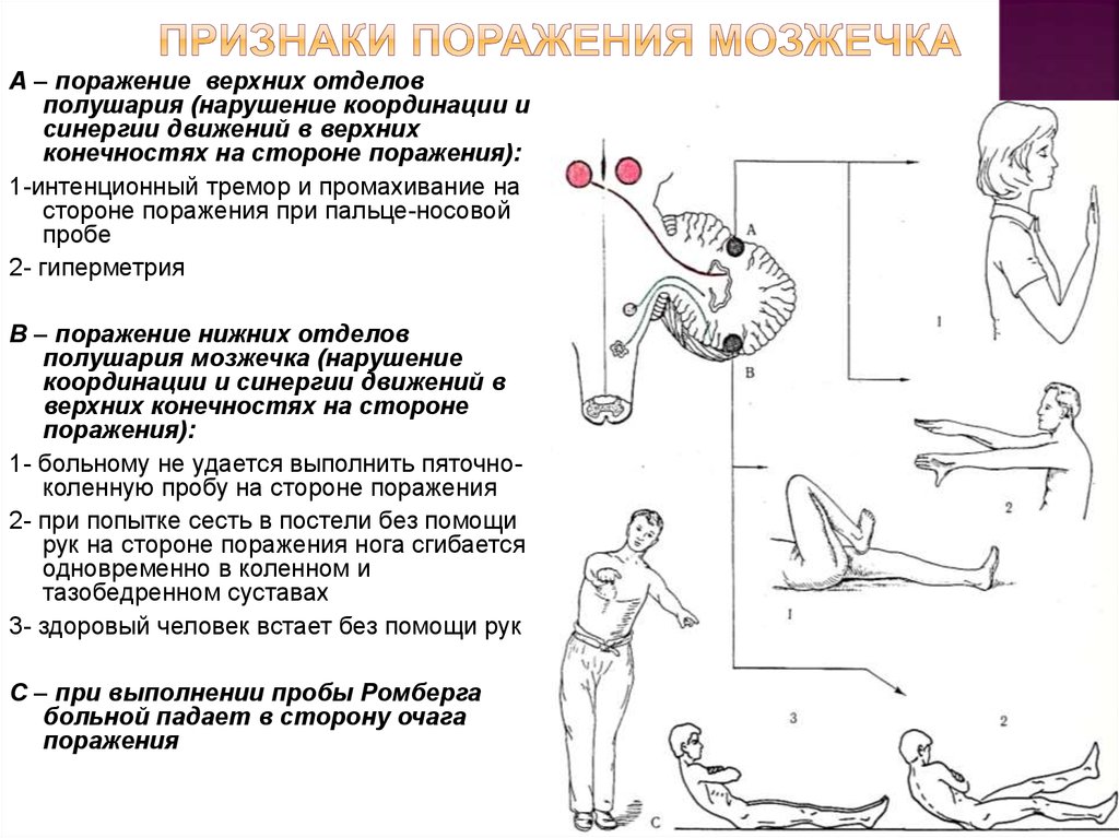 Мозжечок признаки. Симптомы поражения мозжечка неврология. Поражение полушарий мозжечка симптомы. Нарушение функций мозжечка симптомы. Мозжечок функции симптомы поражения.