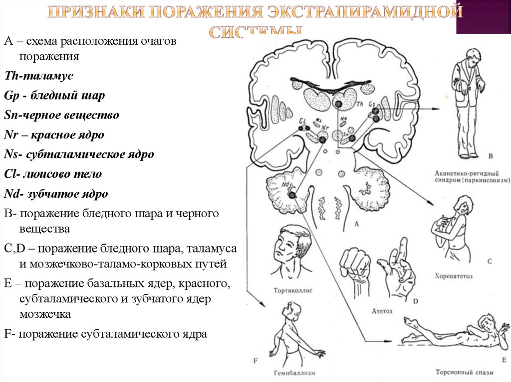 Системы поражения. Экстрапирамидная система симптомы поражения неврология. Уровни поражения экстрапирамидной системы. Синдромы поражения экстрапирамидной системы таблица. Симптомы при поражении экстрапирамидной системы.