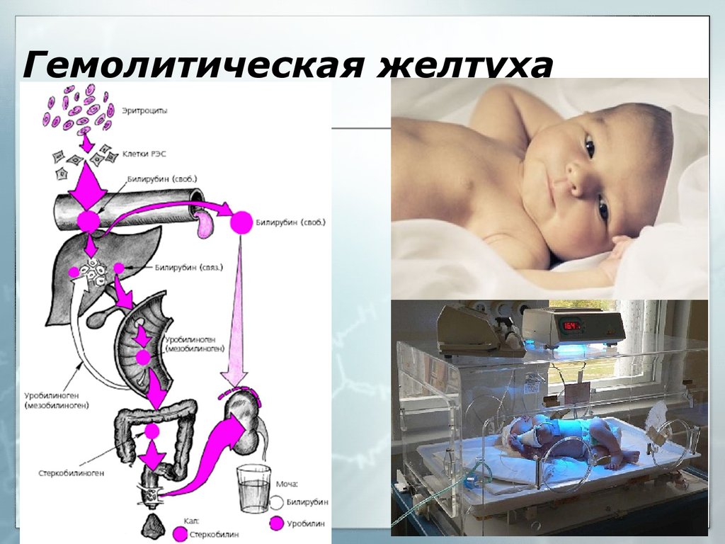 Гбн у новорожденных картинки