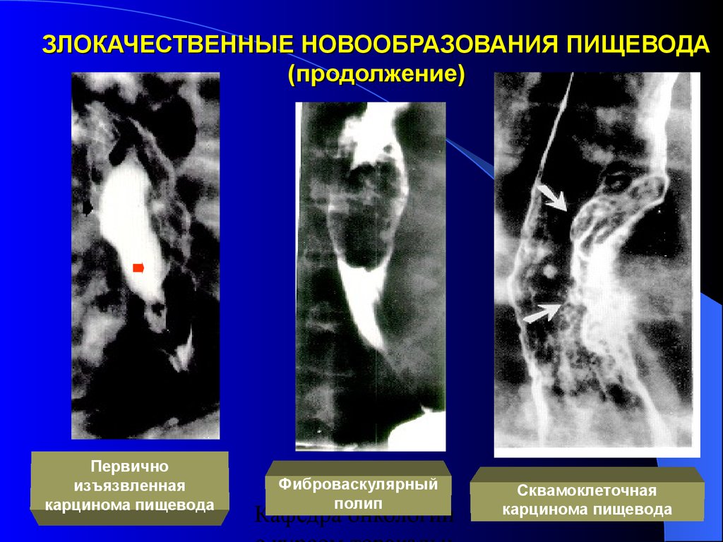 Рентгенологическая картина рака пищевода экзофитный эндофитный