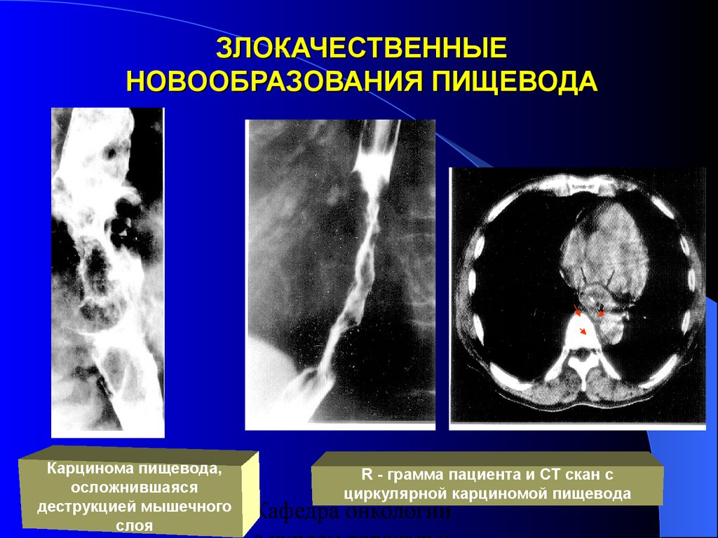 Глиома степени злокачественности. Злокачественные опухоли пищевода. Опухоль средней трети пищевода. Злокачественная опухоль средней трети пищевода.